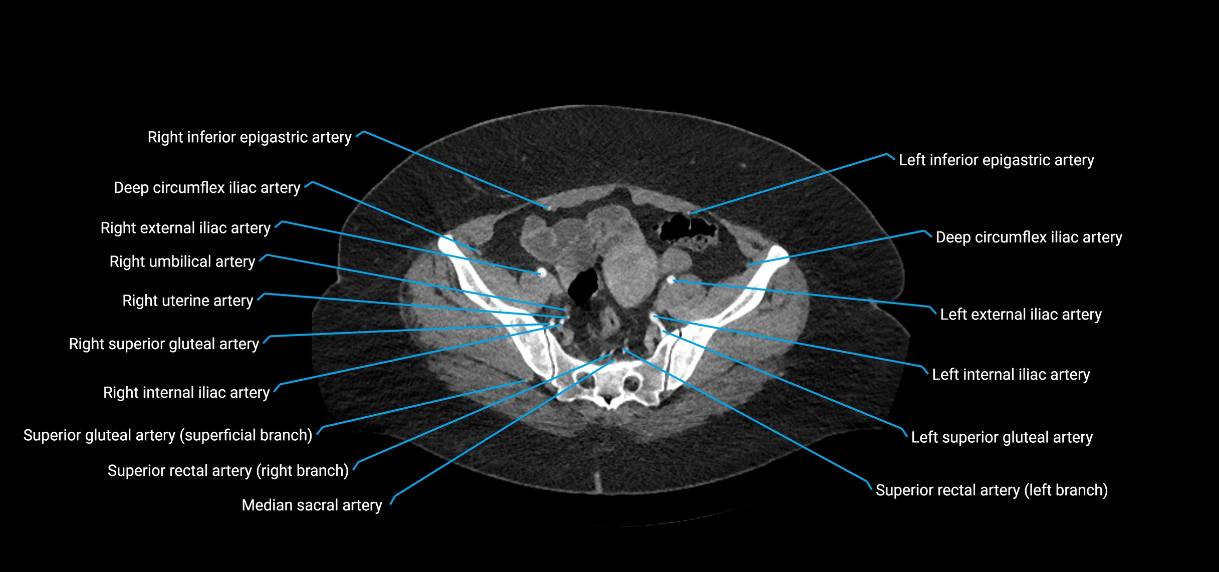 CTA abdomen axial cross sectional anatomy labelled image_203 (2).webp